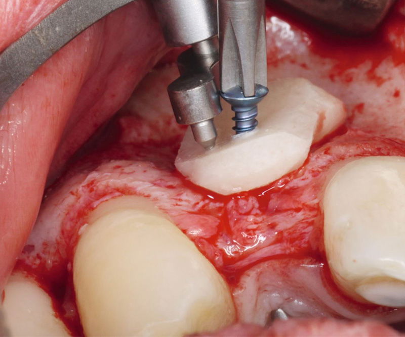 Bone-Fixation-Set,  Ø 1, 0/1, 2mm Implant-Steel, consisting of: Box, Screwdriver, Selfret, Screws, drill