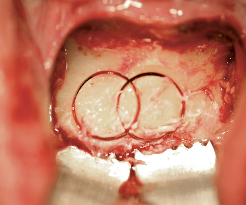 NENTWIG, special retractor, 70x14mm, serr.