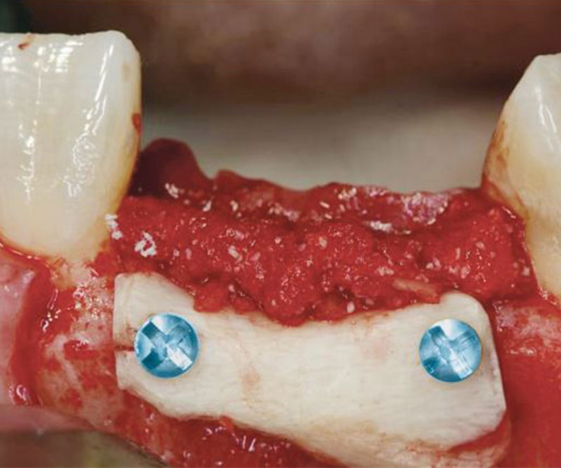 Bone-Fixation-Set,  Ø 1, 0/1, 2mm Implant-Steel, consisting of: Box, Screwdriver, Selfret, Screws, drill