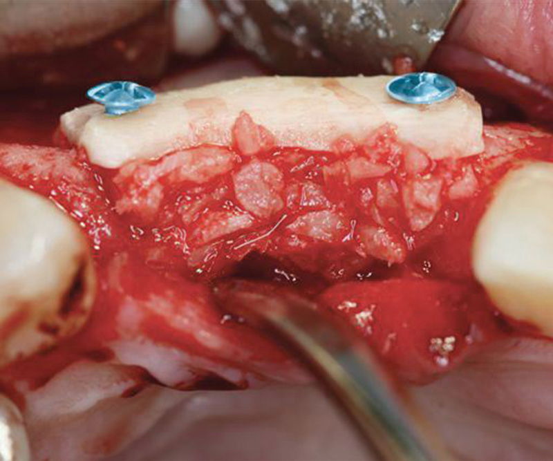 Bone-Fixation-Set,  Ø 1, 0/1, 2mm Implant-Steel, consisting of: Box, Screwdriver, Selfret, Screws, drill