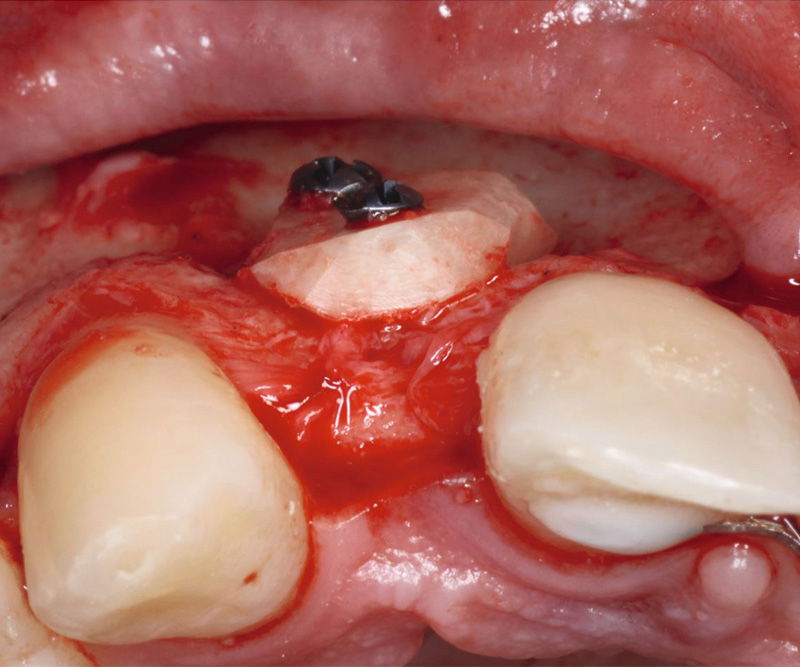 Bone-Fixation-Set,  Ø 1, 0/1, 2mm Implant-Steel, consisting of: Box, Screwdriver, Selfret, Screws, drill