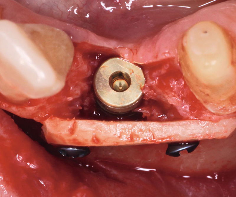 Bone-Fixation-Set,  Ø 1, 0/1, 2mm Implant-Steel, consisting of: Box, Screwdriver, Selfret, Screws, drill