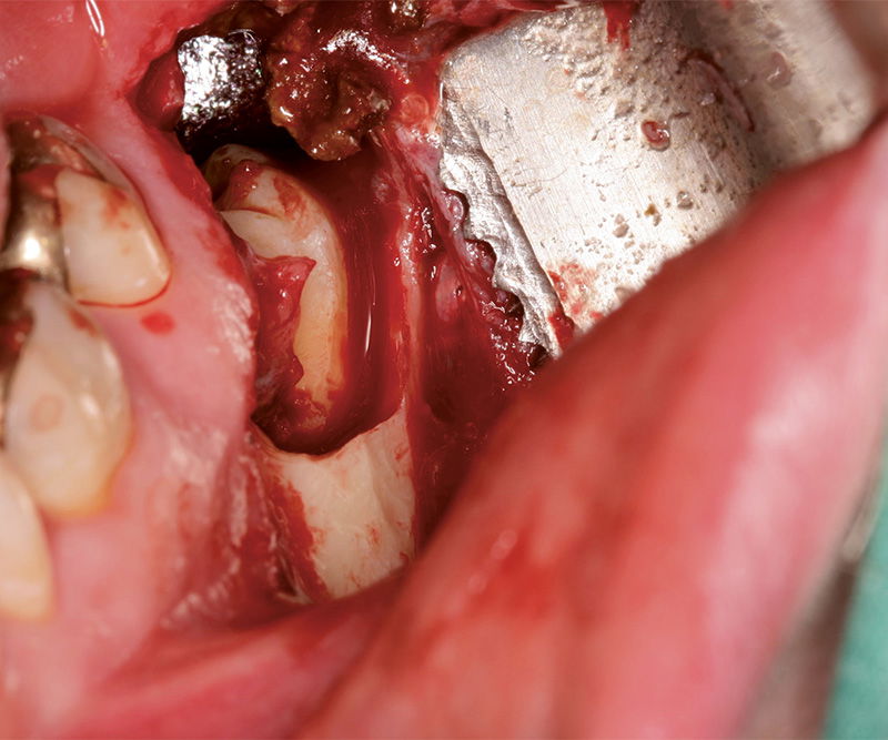 NENTWIG, special retractor, 70x14mm, serr.