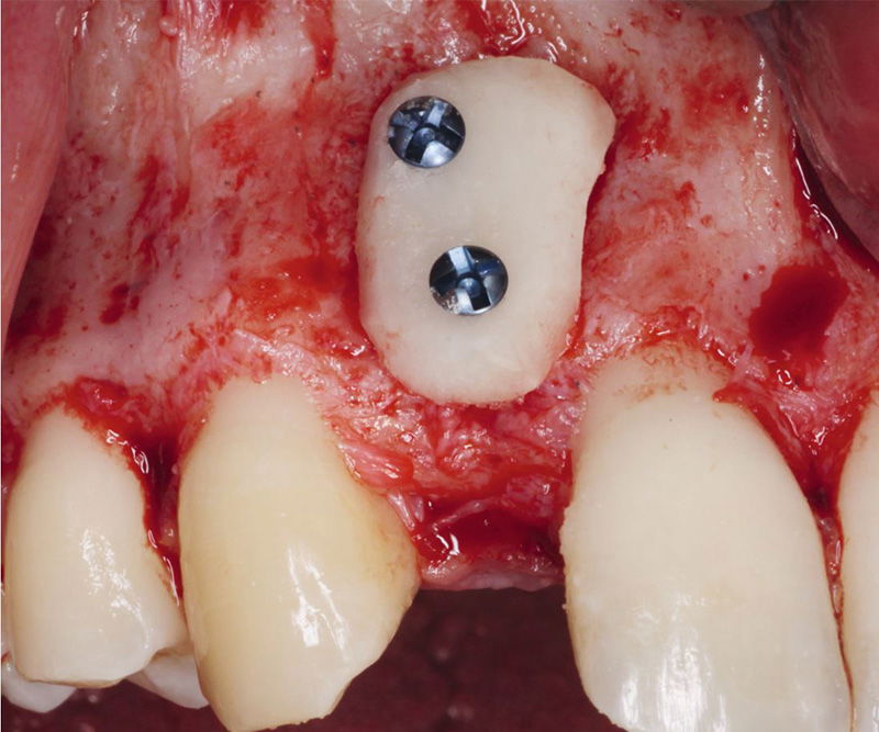 Bone-Fixation-Set,  Ø 1, 0/1, 2mm Implant-Steel, consisting of: Box, Screwdriver, Selfret, Screws, drill