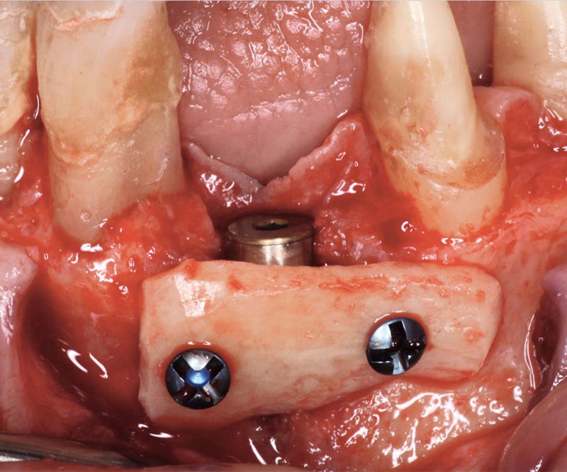 Bone-Fixation-Set, ¶ 1, 0/1, 2/1, 4/1, 6mm Titan, consisting of: Box, Screwdriver, Selfret, Screws, drill